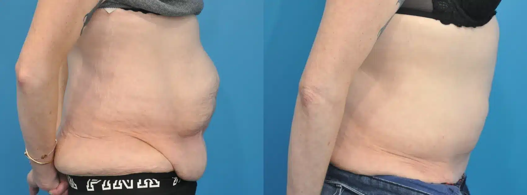 Before and After Image: Case #347 - right-side