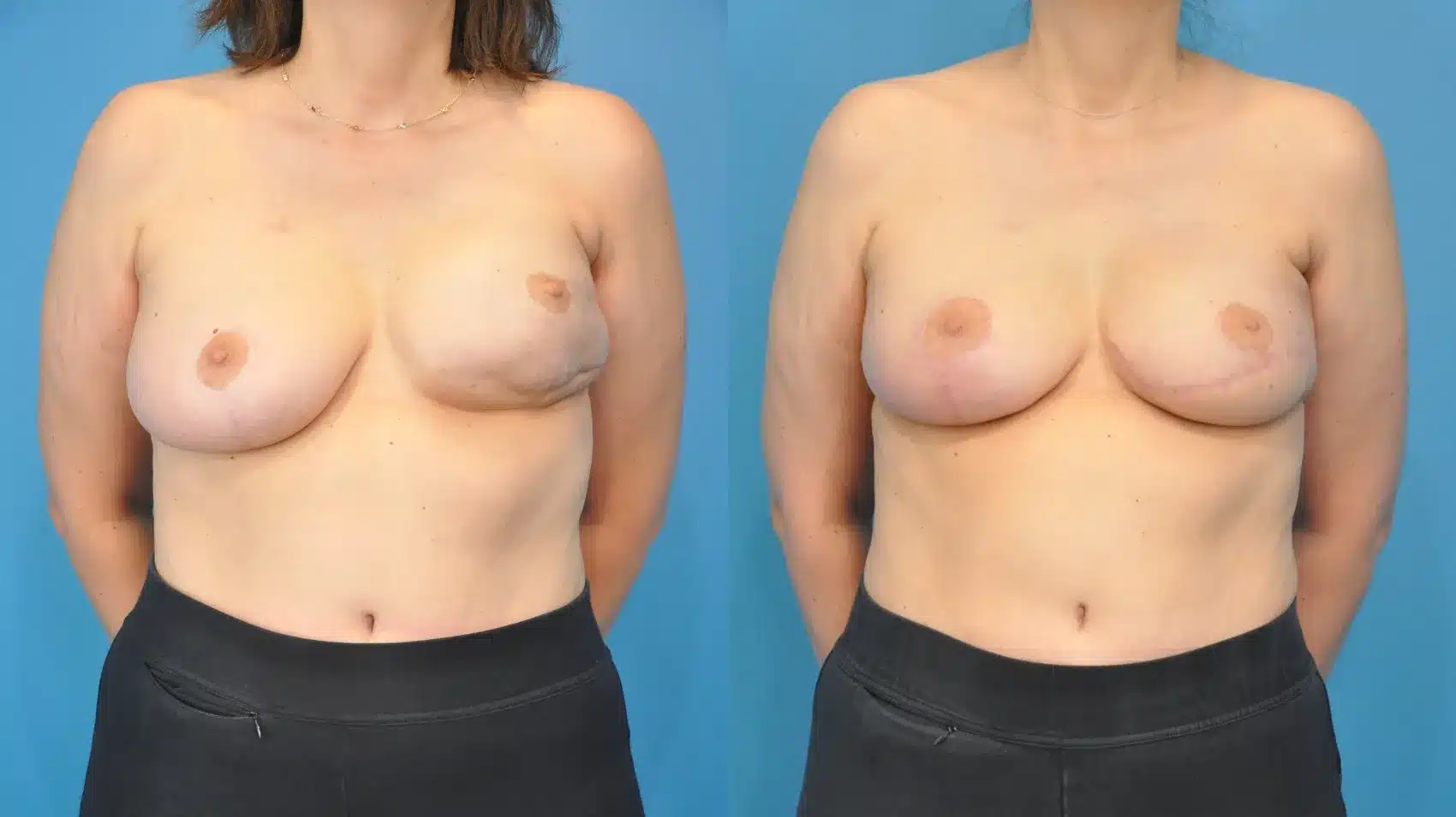 Before and After Image: Revision Breast Reconstruction with Latissumus Flap - front