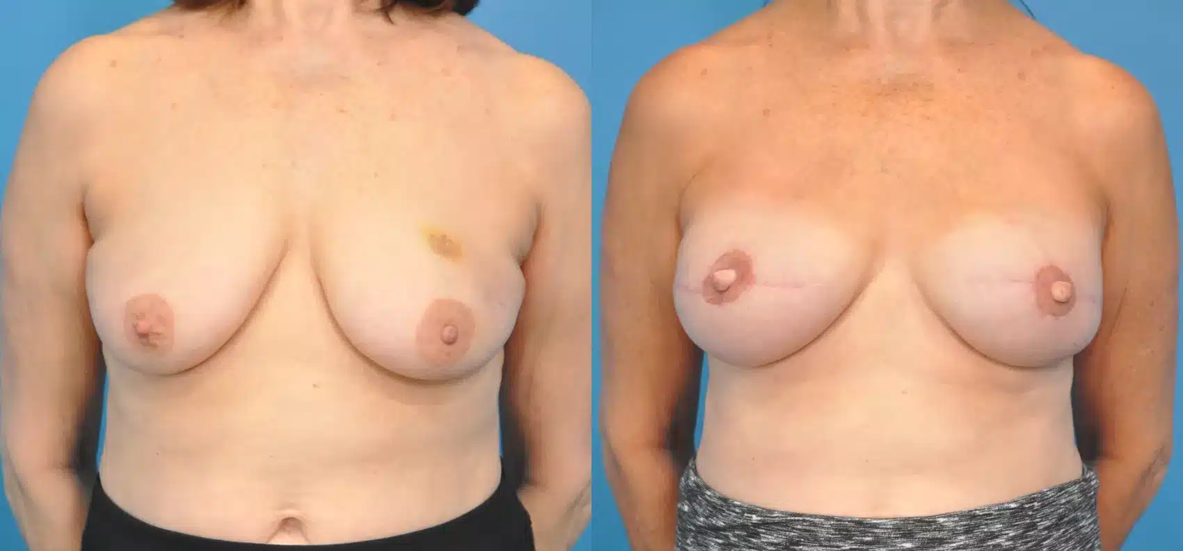 Before and After Image: Case #35 - front