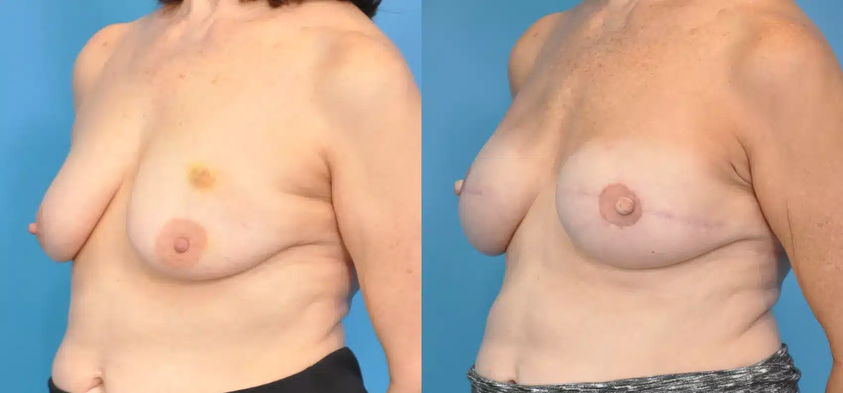 Before and After Image: Case #35 - left-front-oblique