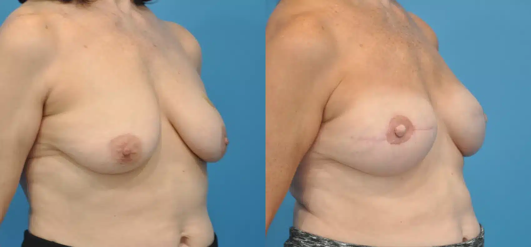 Before and After Image: Case #35 - right-front-oblique
