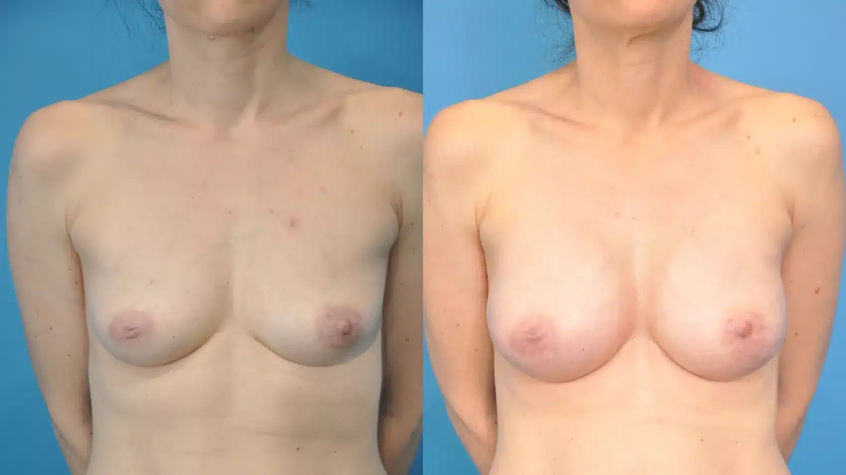 Before and After Image: Case #350 - front