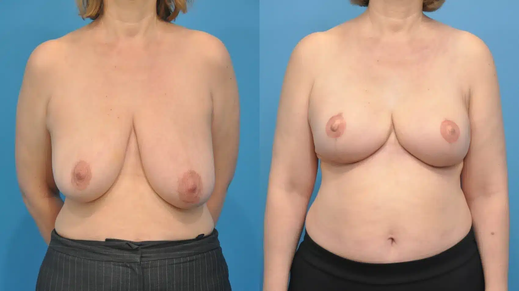 Before and After Image: Breast Reconstruction with Implants - front