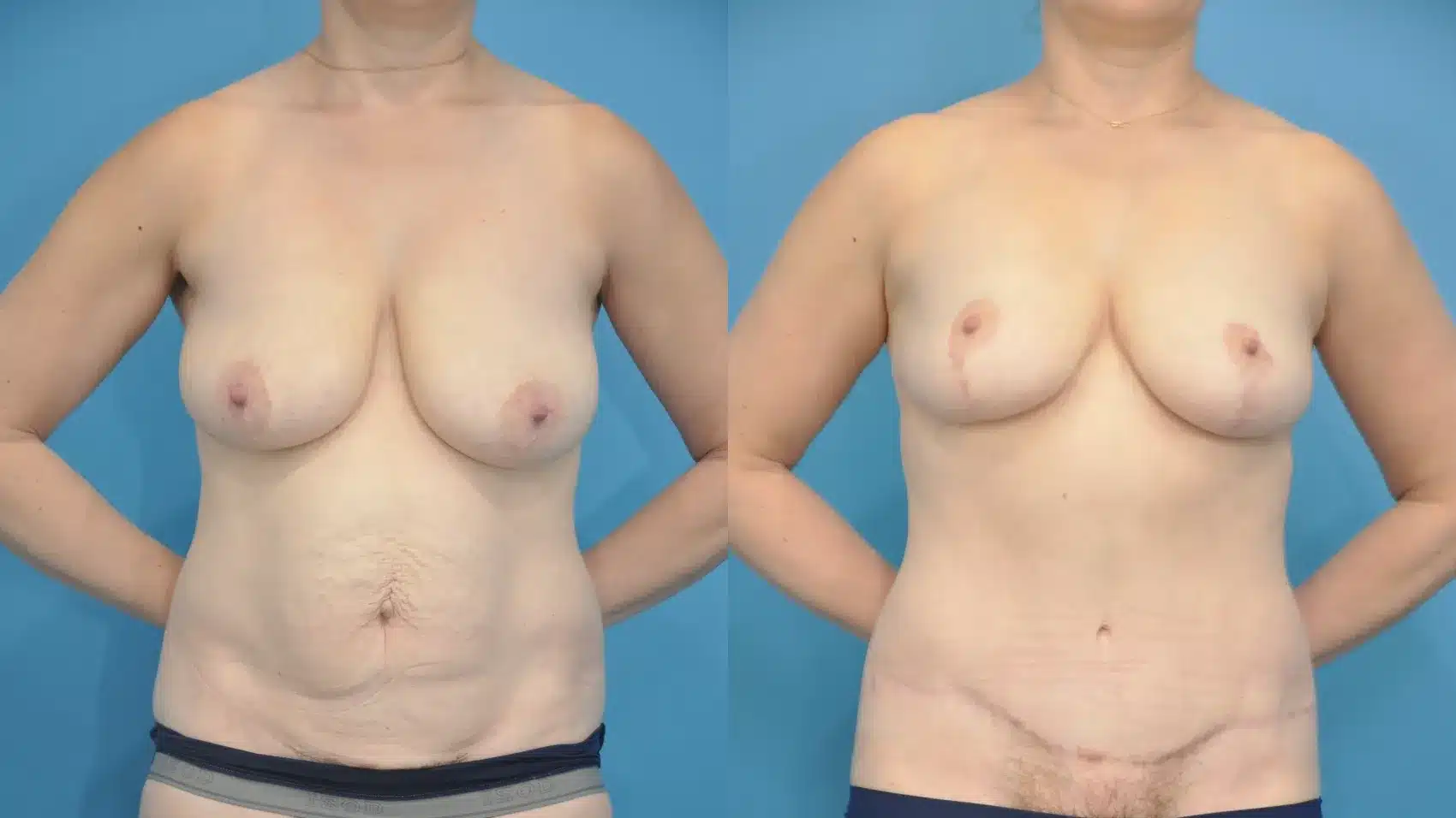 Before and After Image: Breast Lift and Abdominoplasty - front