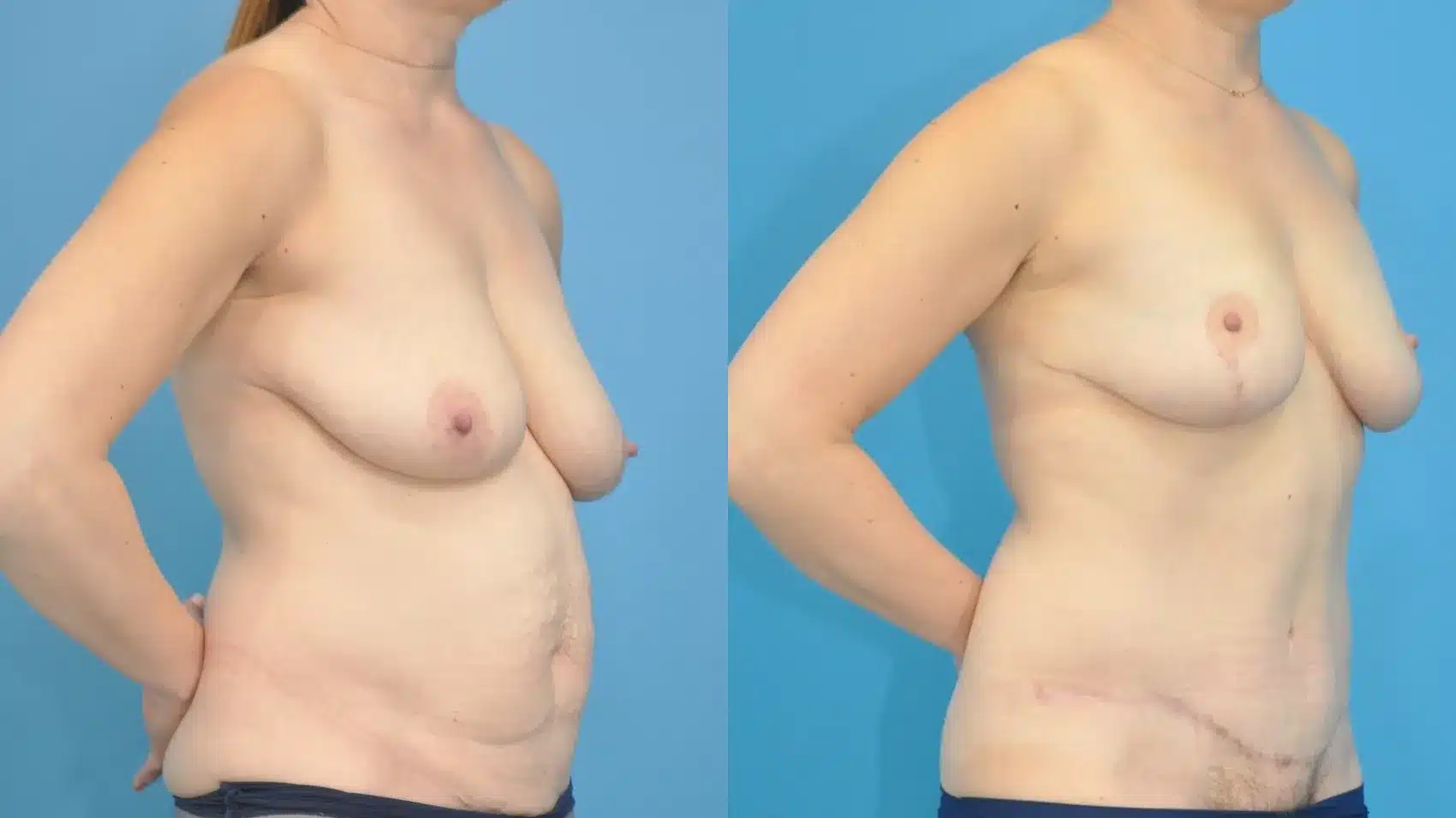 Before and After Image: Breast Lift and Abdominoplasty - right-front-oblique