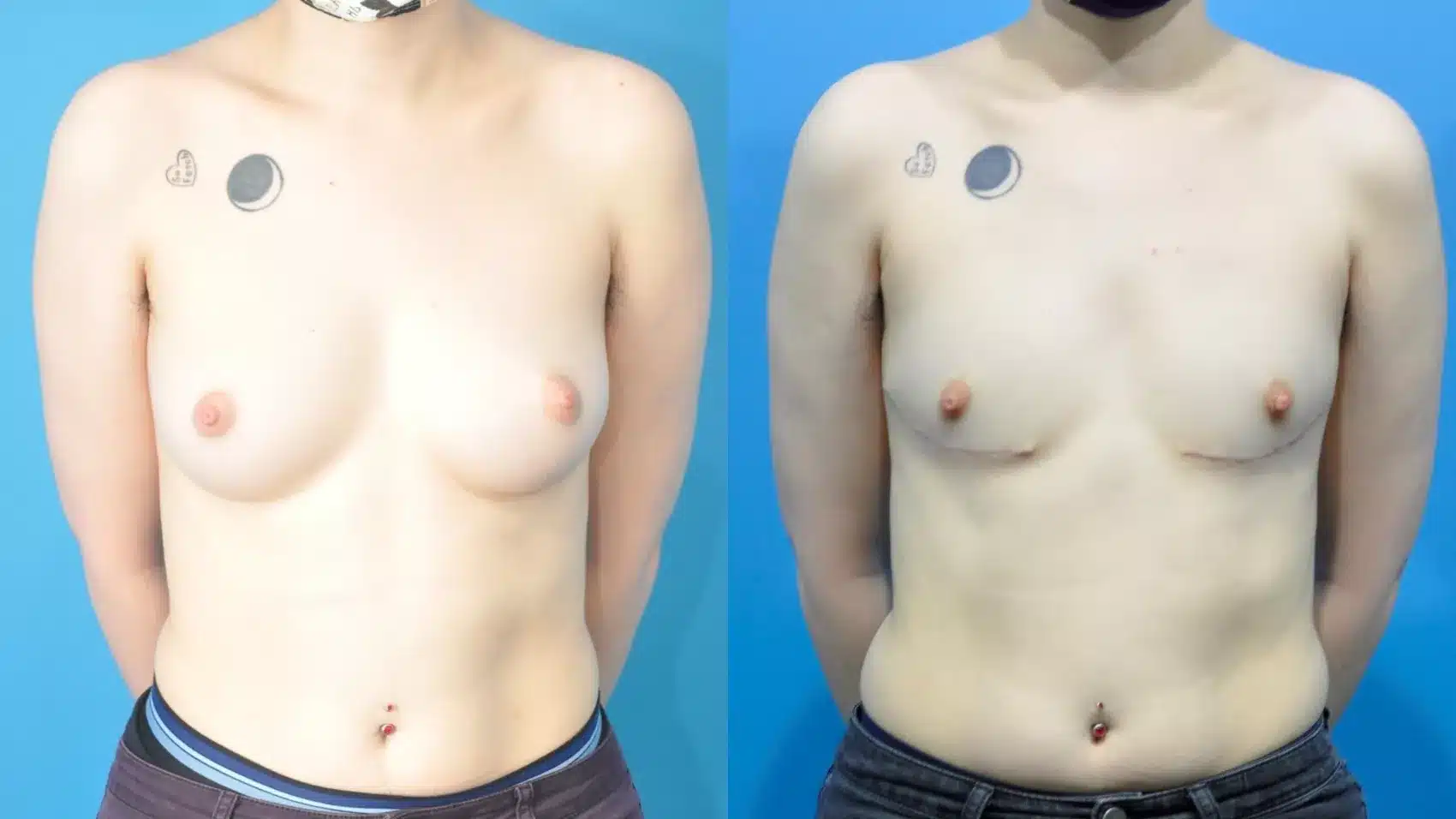 Before and After Image: Case #354 - front