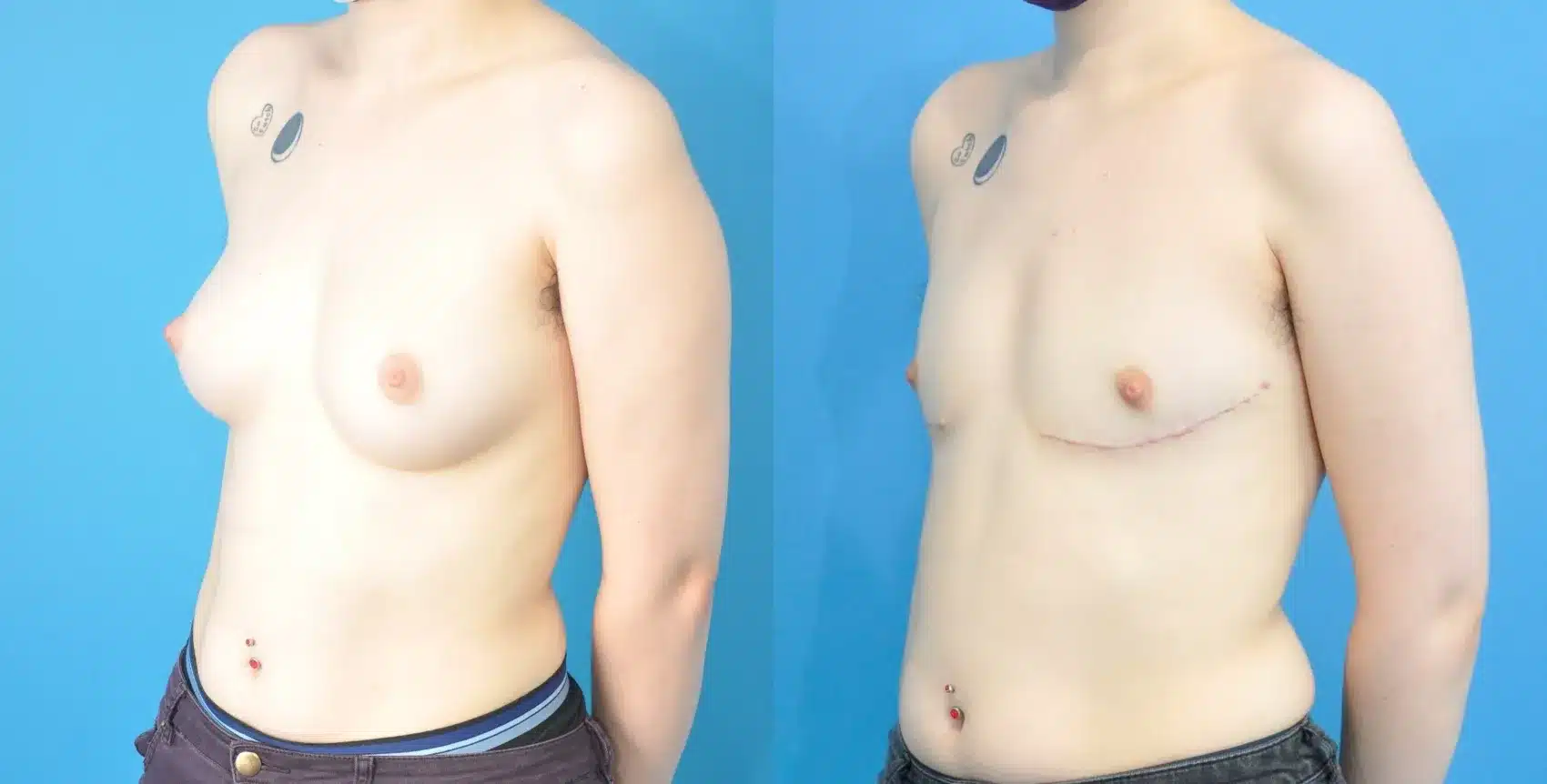 Before and After Image: Case #354 - left-front-oblique