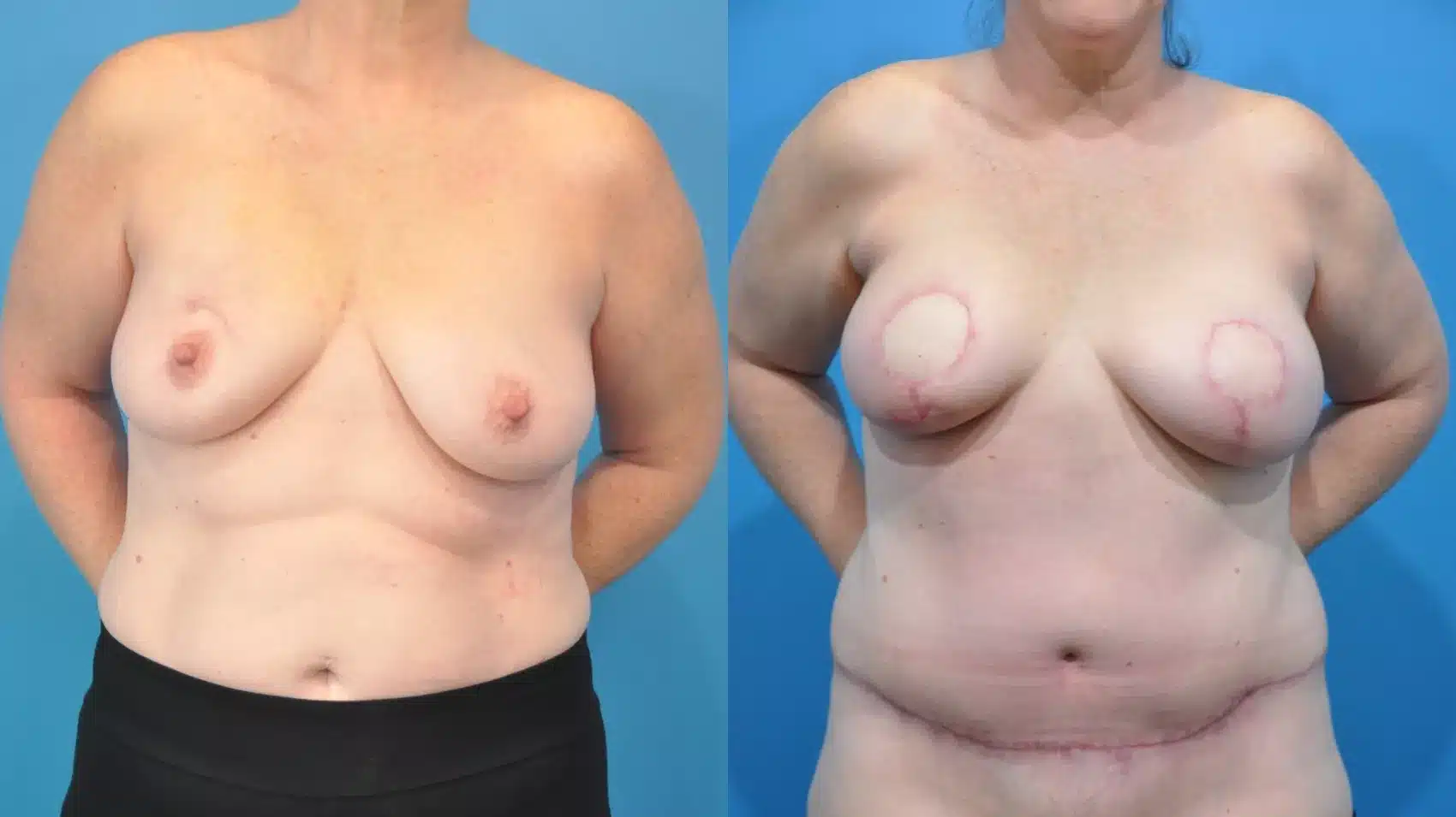 Before and After Image: Case #355 - front