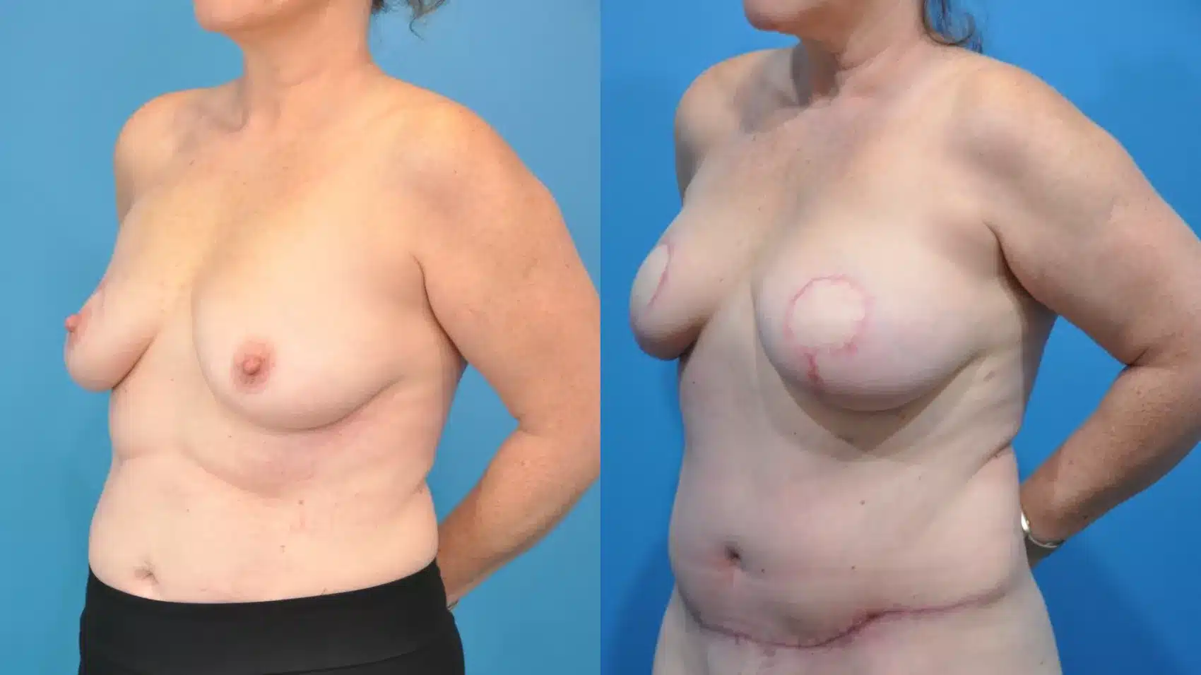 Before and After Image: Case #355 - left-front-oblique