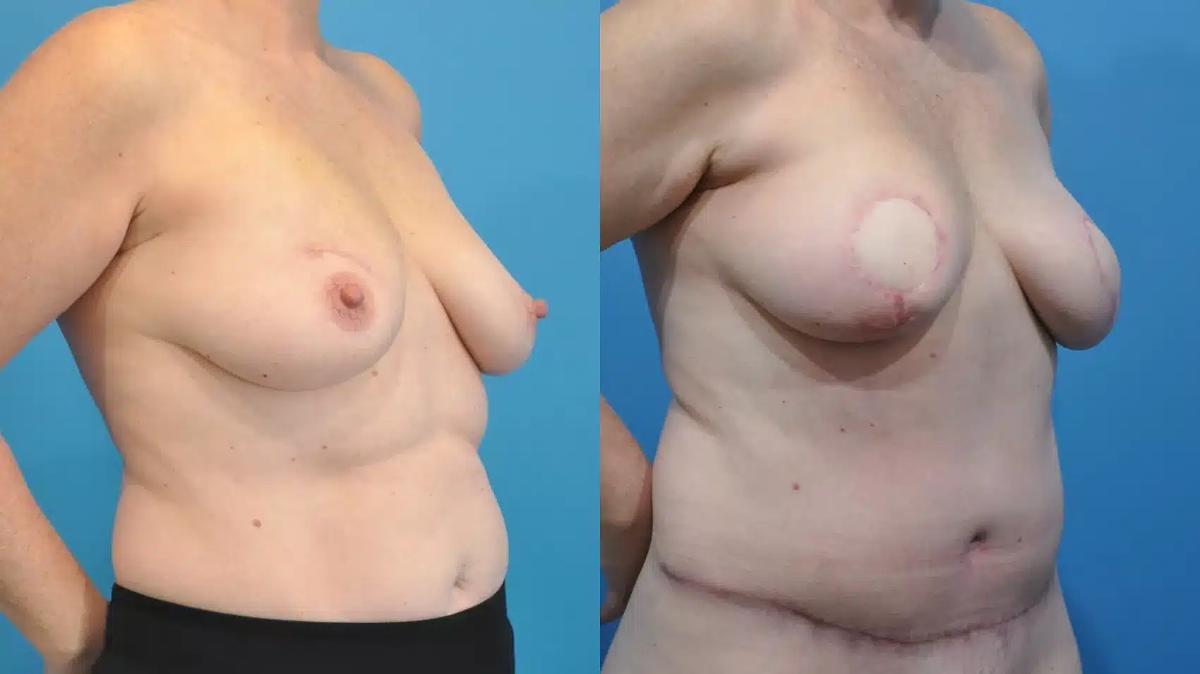 Before and After Image: Case #355 - right-front-oblique