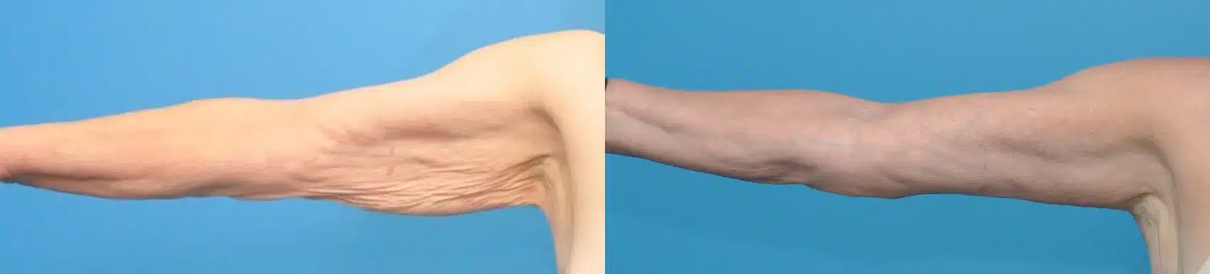 Before and After Image: Brachioplasty (Arm Lift) - front