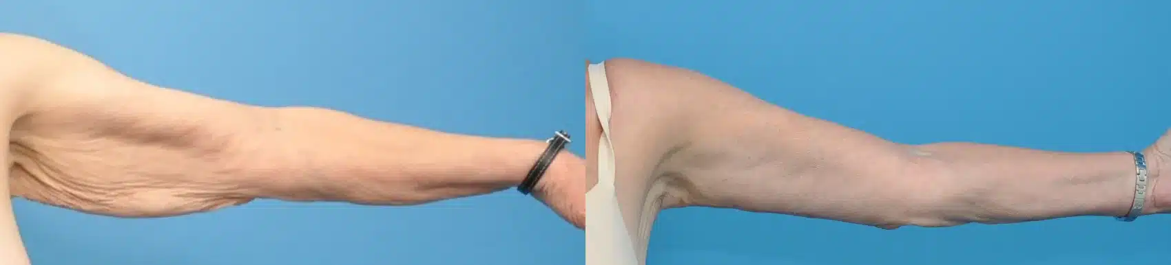 Before and After Image: Brachioplasty (Arm Lift) - front