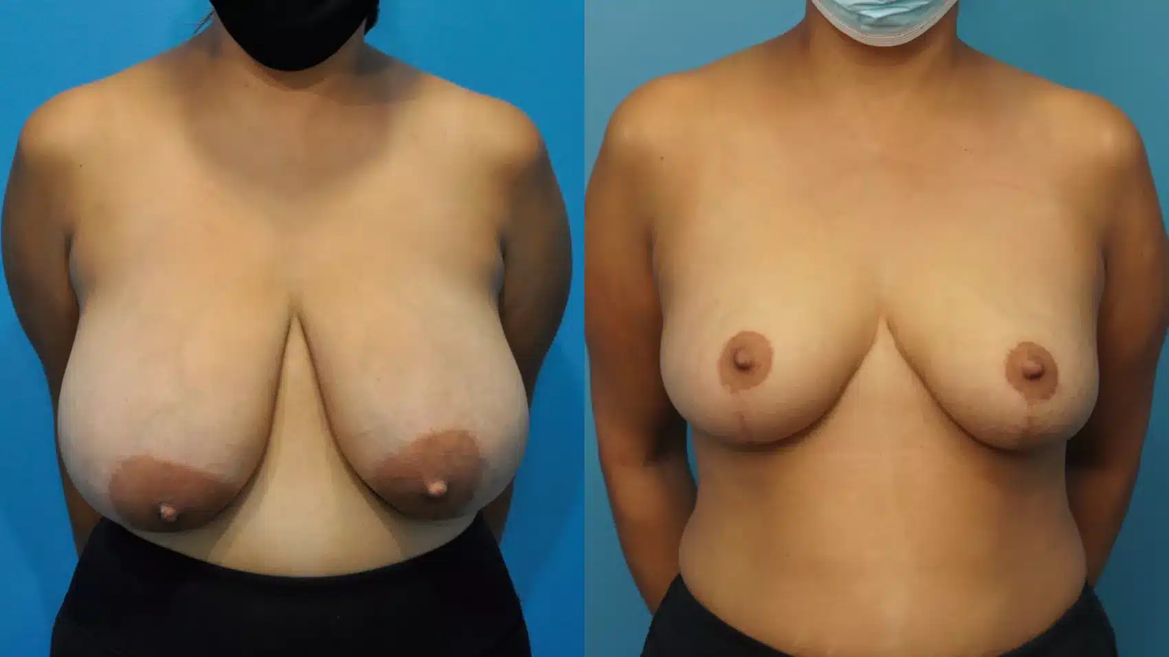 Before and After Image: Case #360 - front