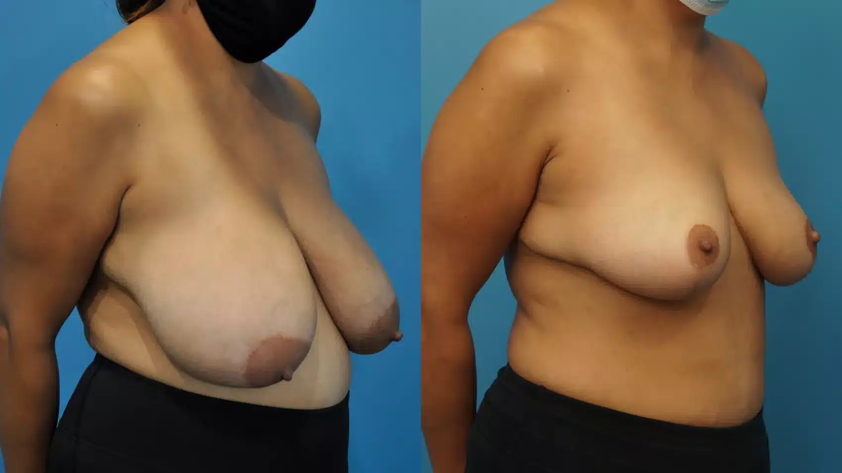 Before and After Image: Case #360 - right-front-oblique