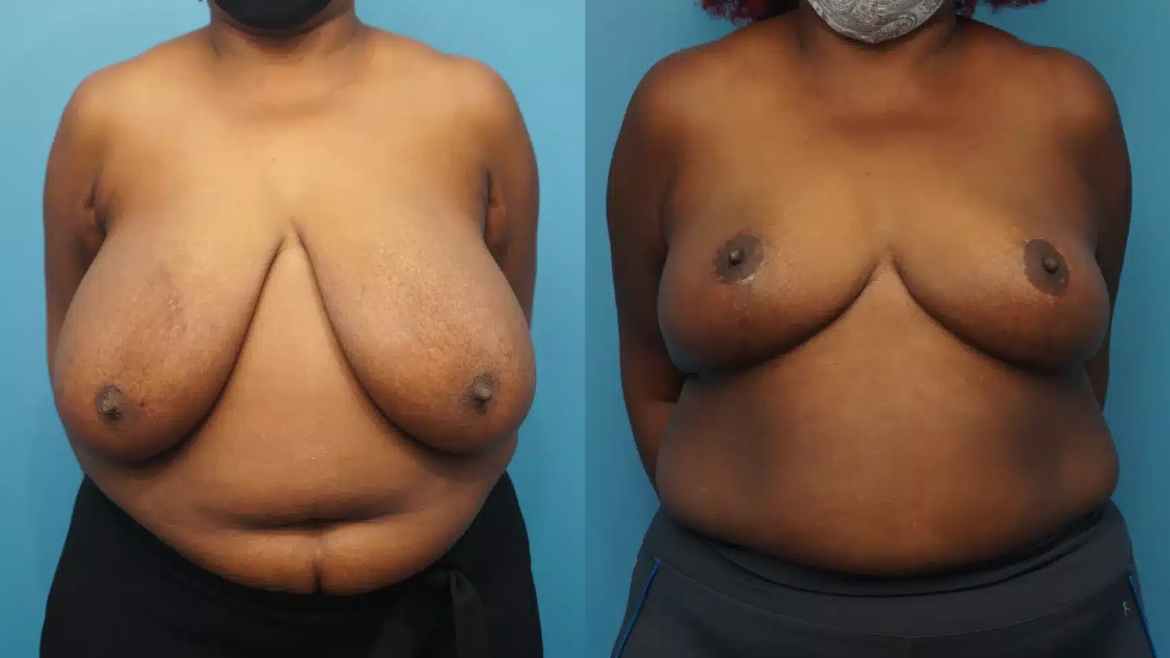 Before and After Image: Case #362 - front