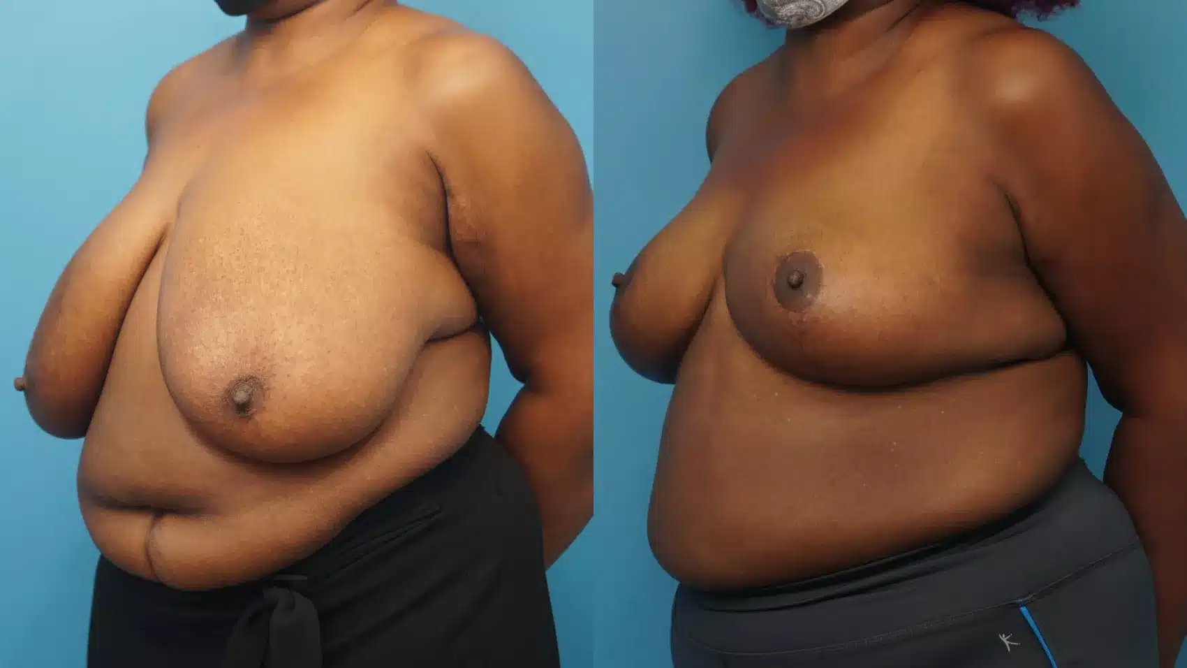 Before and After Image: Case #362 - left-front-oblique