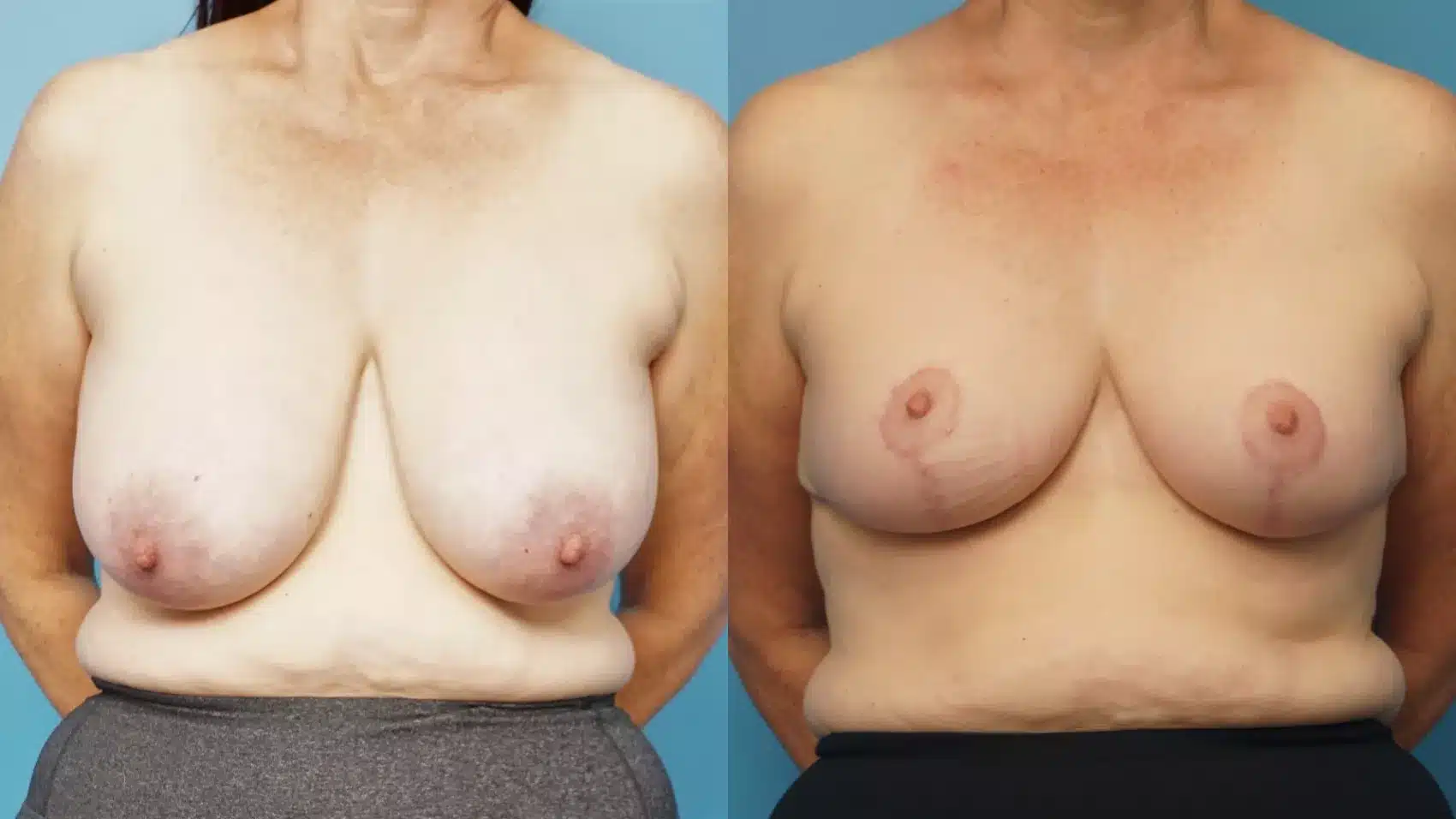 Before and After Image: Case #363 - front