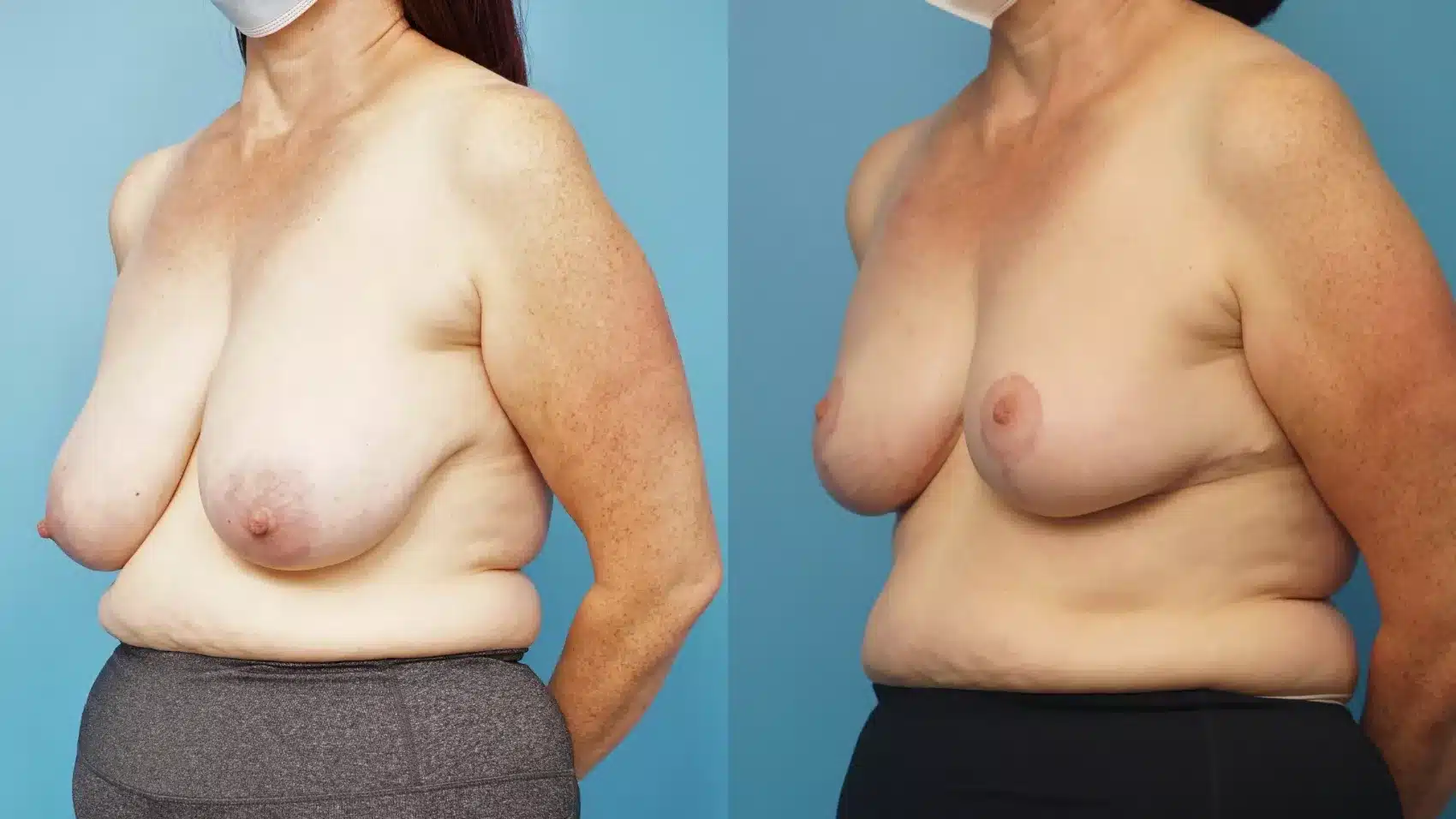 Before and After Image: Case #363 - left-front-oblique