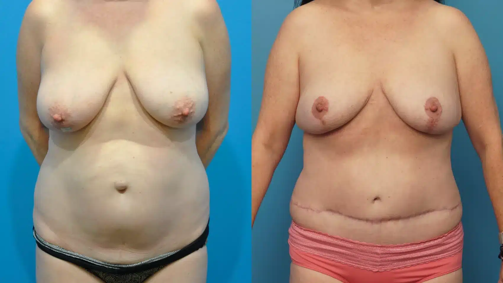 Before and After Image: Case #364 - front