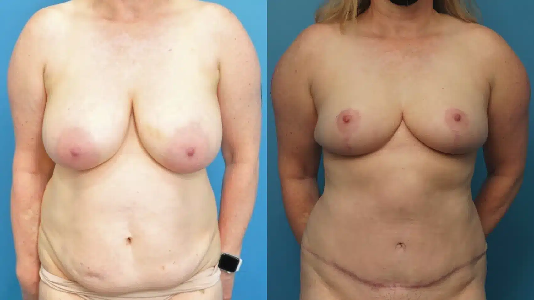 Before and After Image: Abdominoplasty and Breast Lift - front