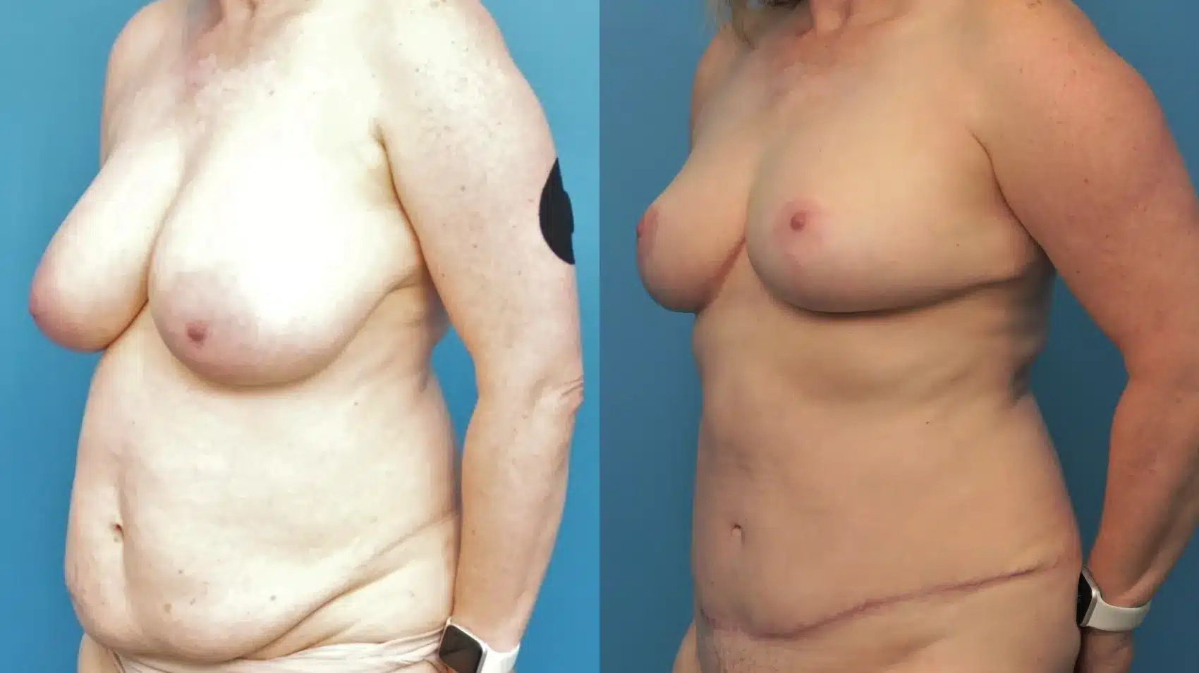 Before and After Image: Abdominoplasty and Breast Lift - left-front-oblique