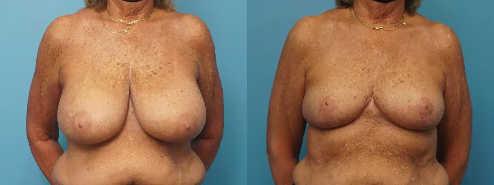 Before and After Image: Oncoplastic Reduction and Lift for Breast Cancer - front