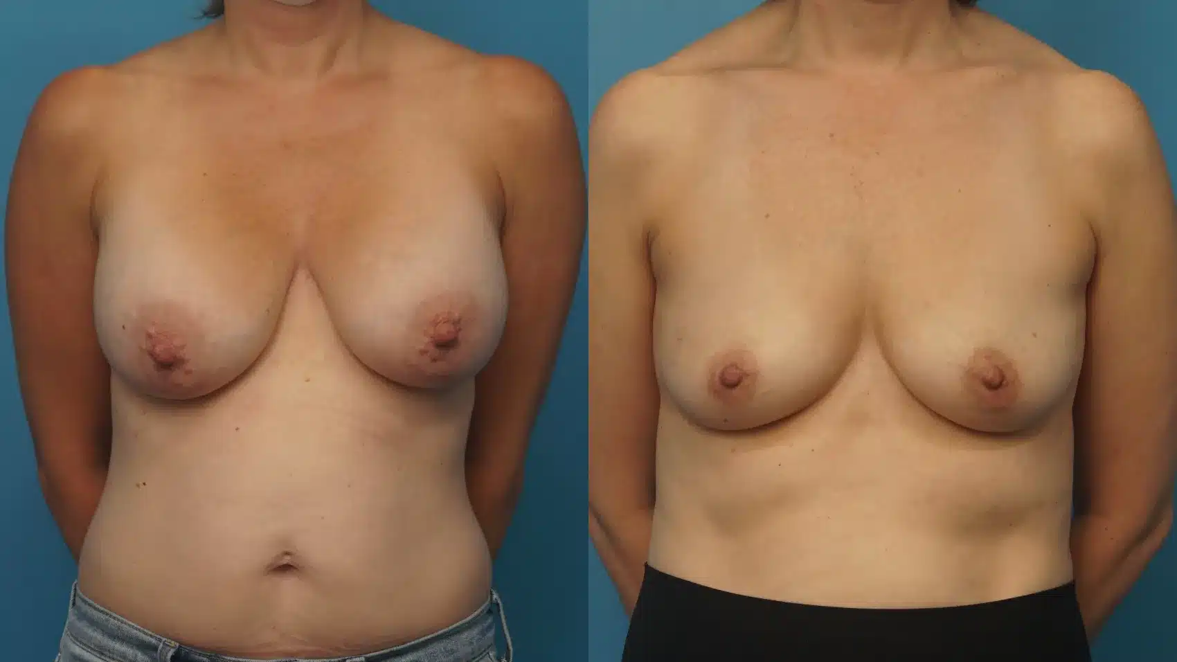 Before and After Image: Breast Implant Removal - front