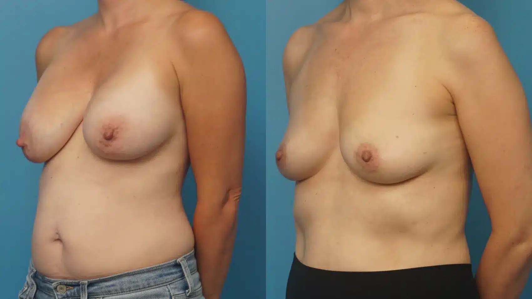 Before and After Image: Breast Implant Removal - left-front-oblique