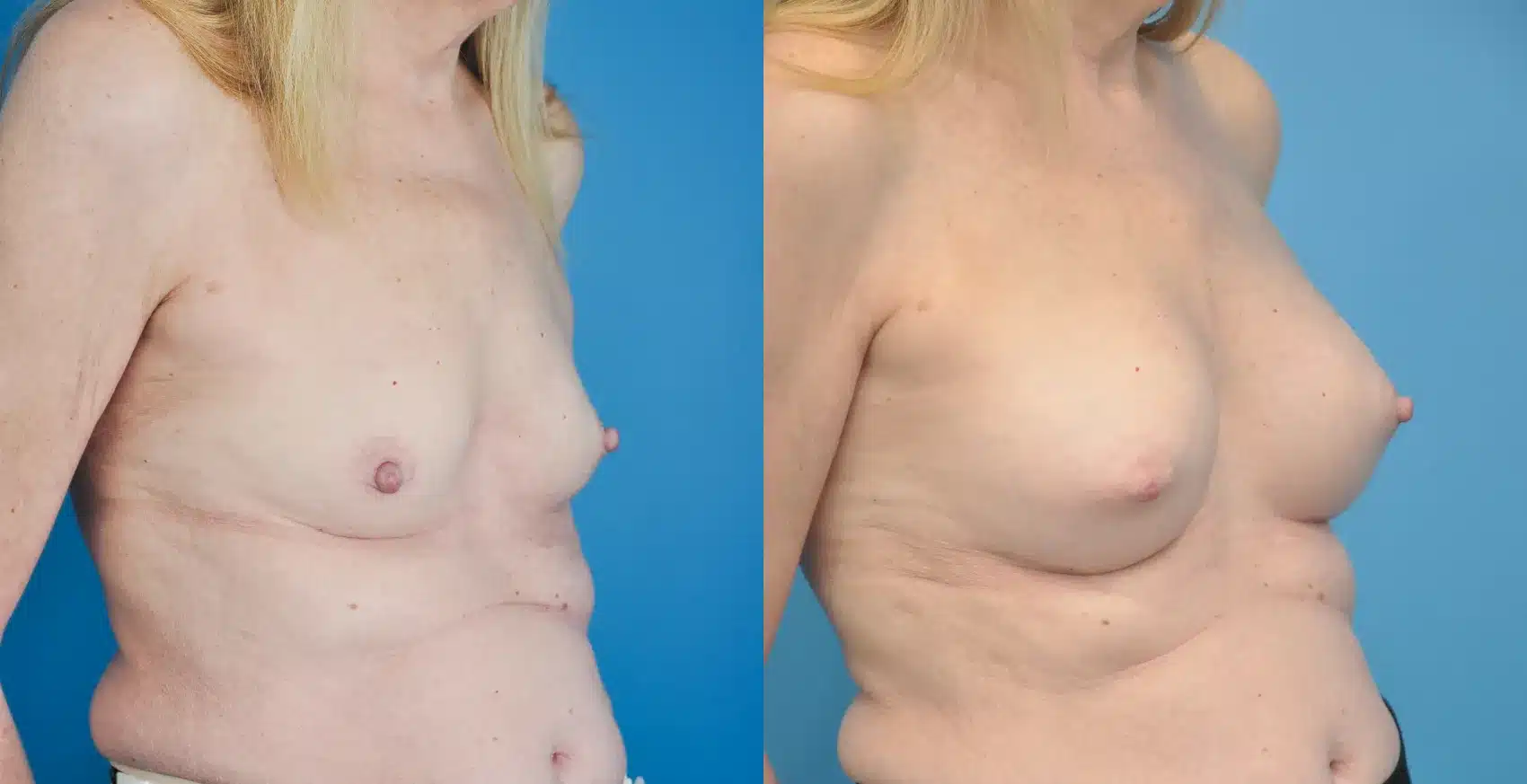 Before and After Image: Breast Augmentation 275ml Silicone - right-front-oblique