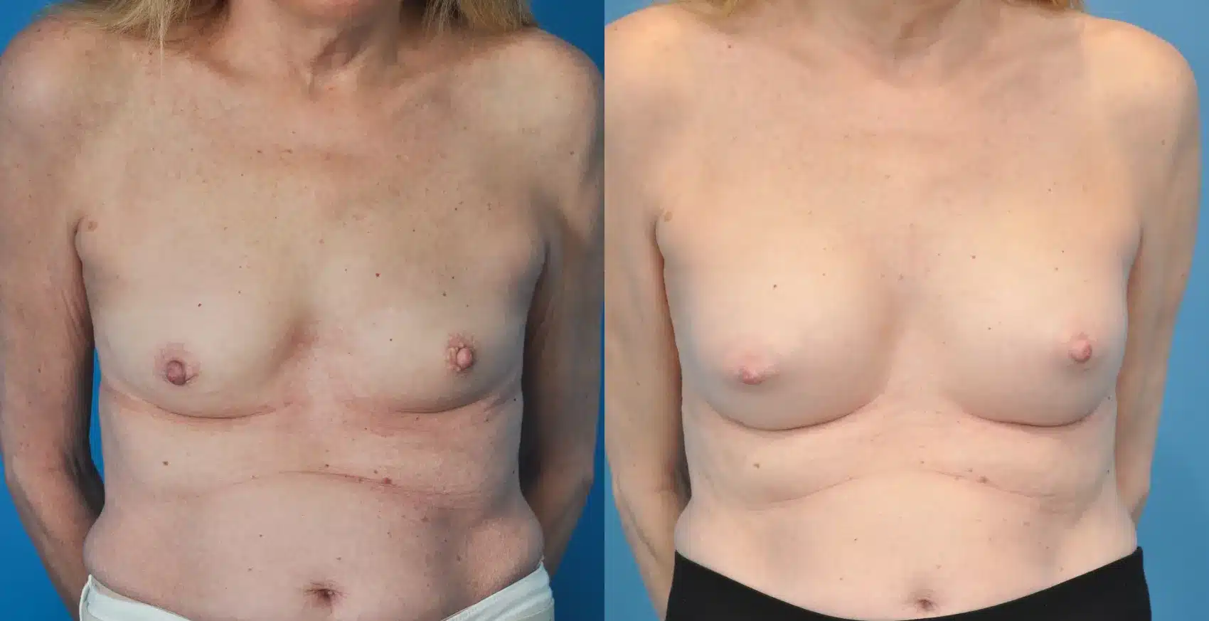 Before and After Image: Breast Augmentation 275ml Silicone - front