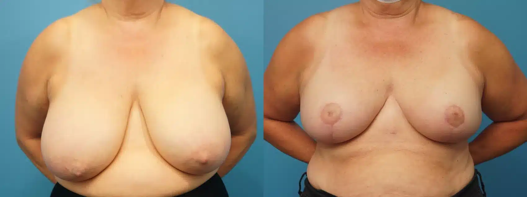 Before and After Image: Case #370 - front