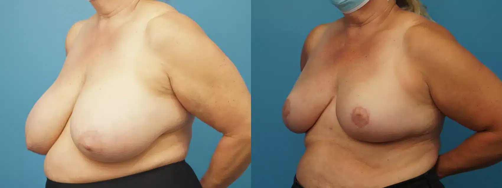 Before and After Image: Case #370 - left-front-oblique