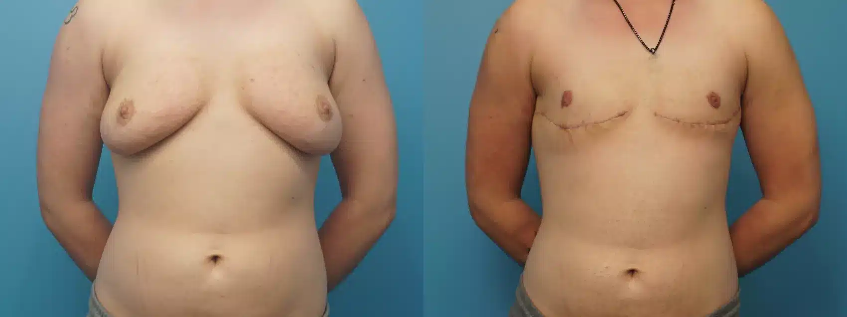 Before and After Image: Case #374 - front