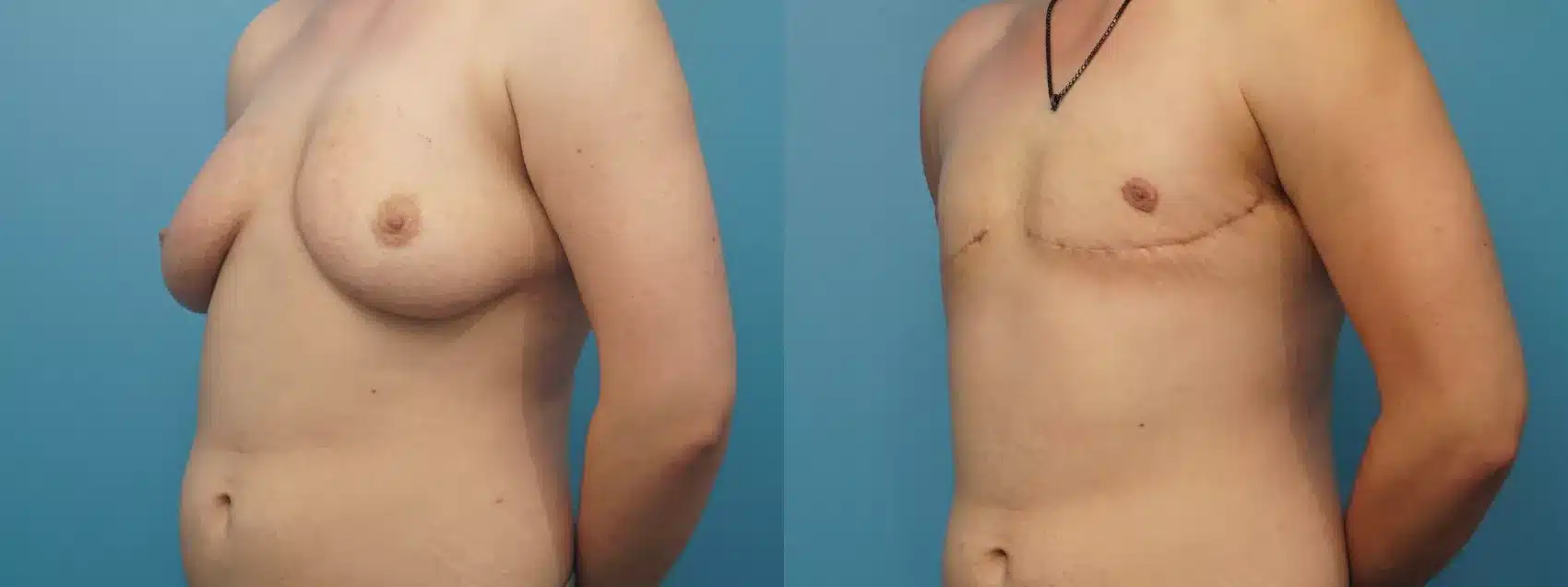 Before and After Image: Case #374 - left-front-oblique