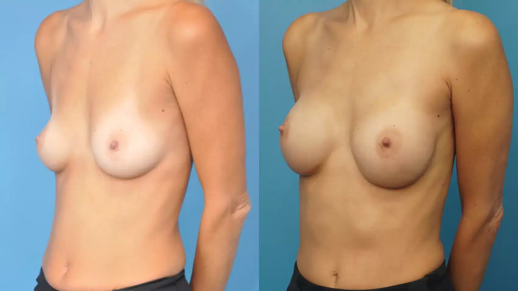 Before and After Image: Case #376 - left-front-oblique