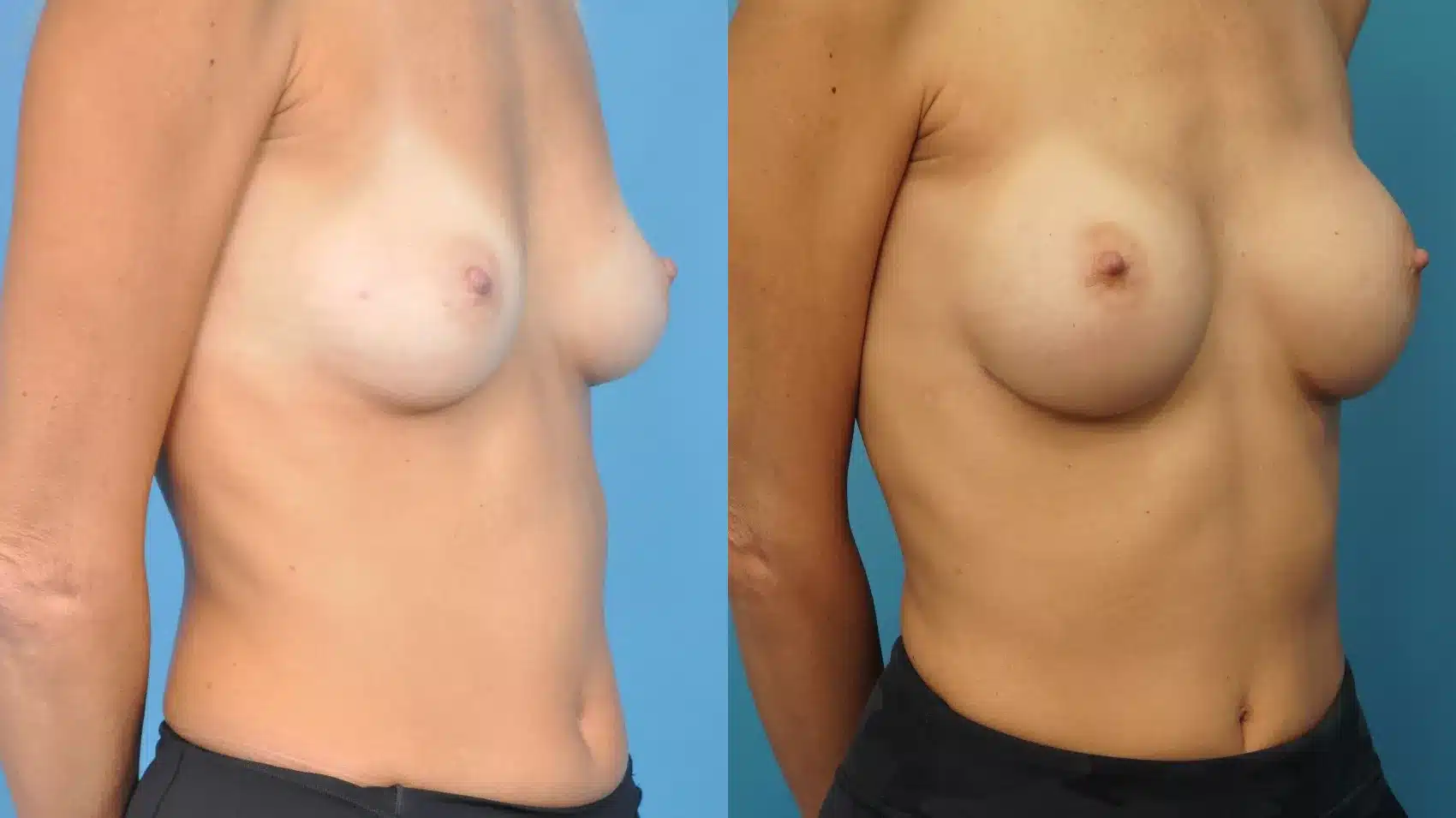 Before and After Image: Case #376 - right-front-oblique