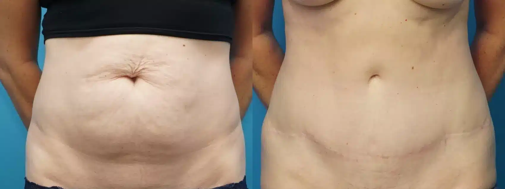 Before and After Image: Case #377 - front