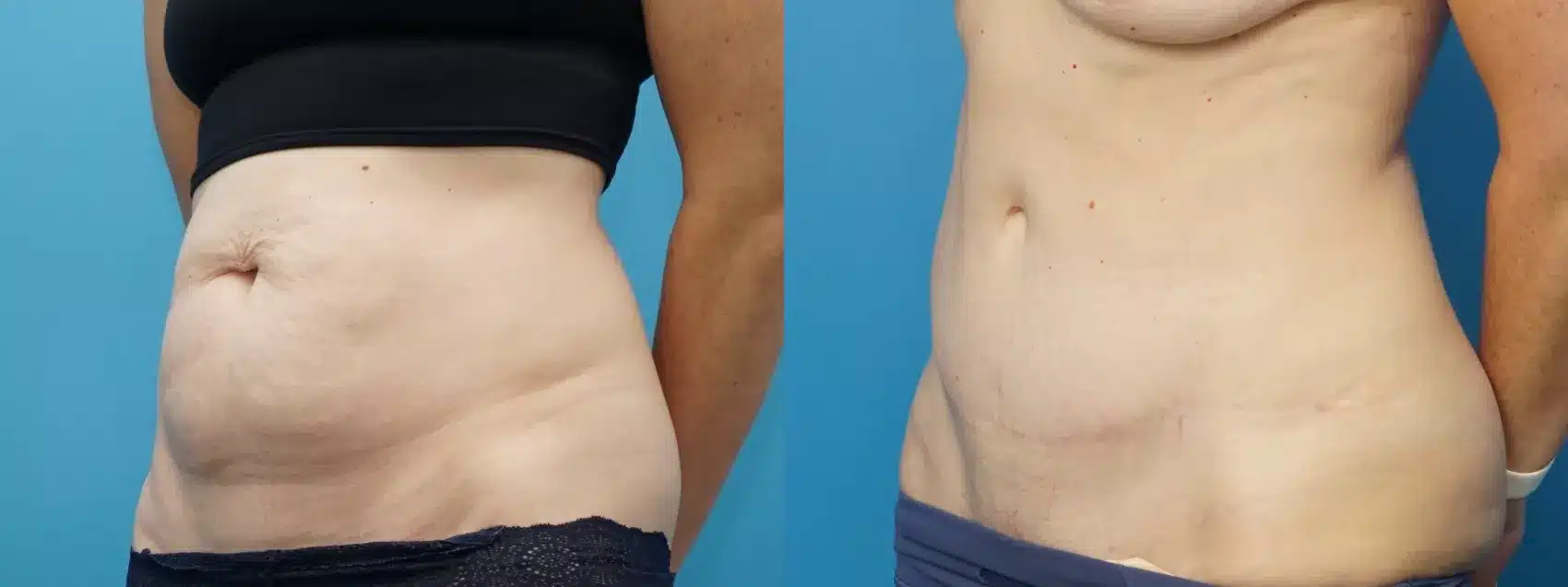Before and After Image: Case #377 - left-front-oblique