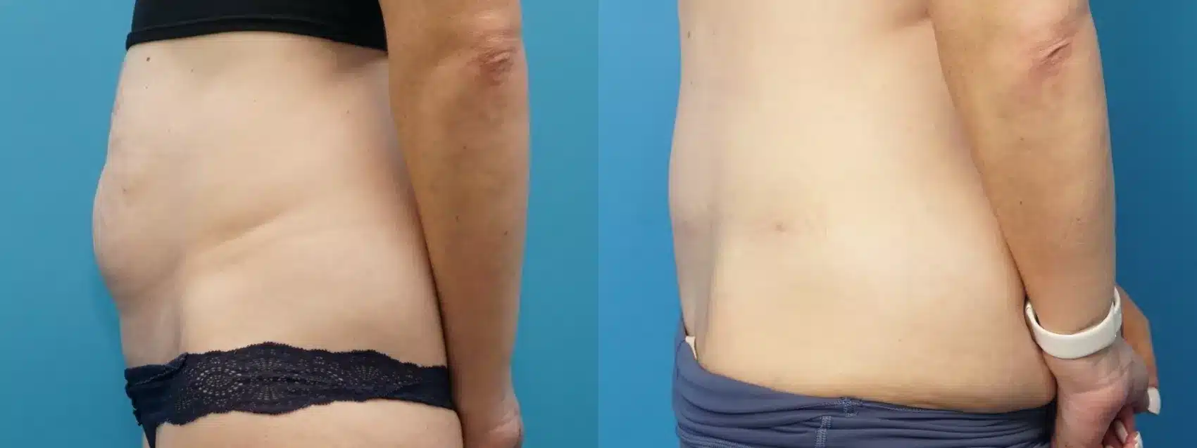 Before and After Image: Case #377 - left-side
