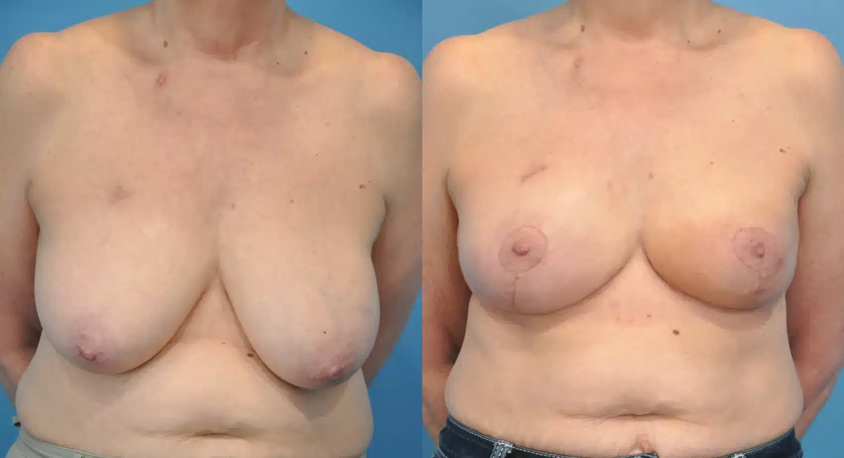 Before and After Image: Case #38 - front