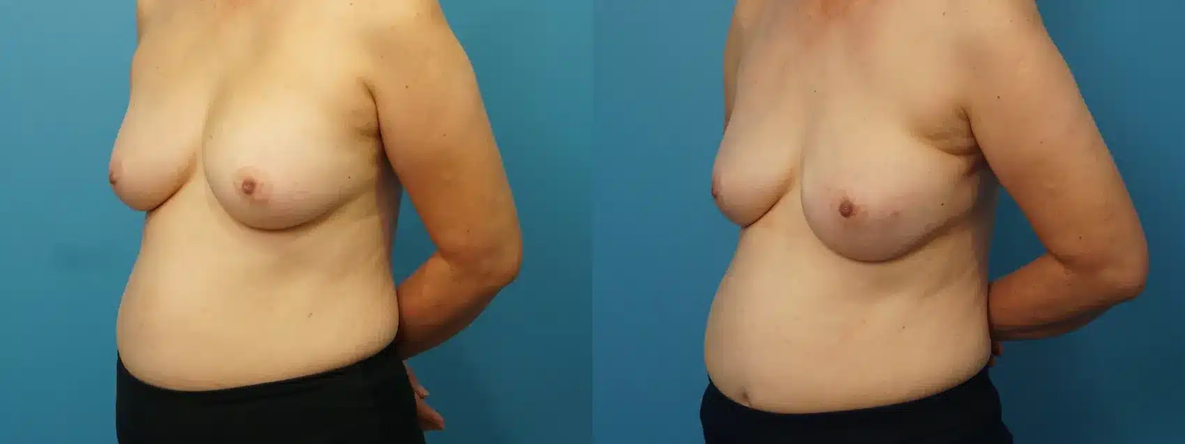 Before and After Image: Implant Mastectomy Reconstruction - left-front-oblique
