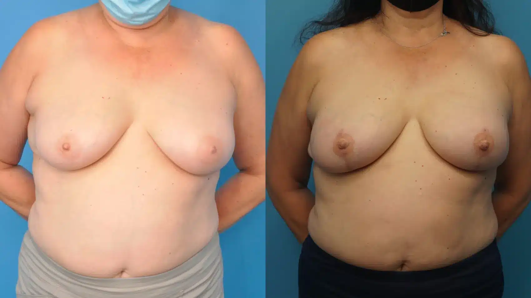 Before and After Image: Mastectomy Reconstruction with implants - front