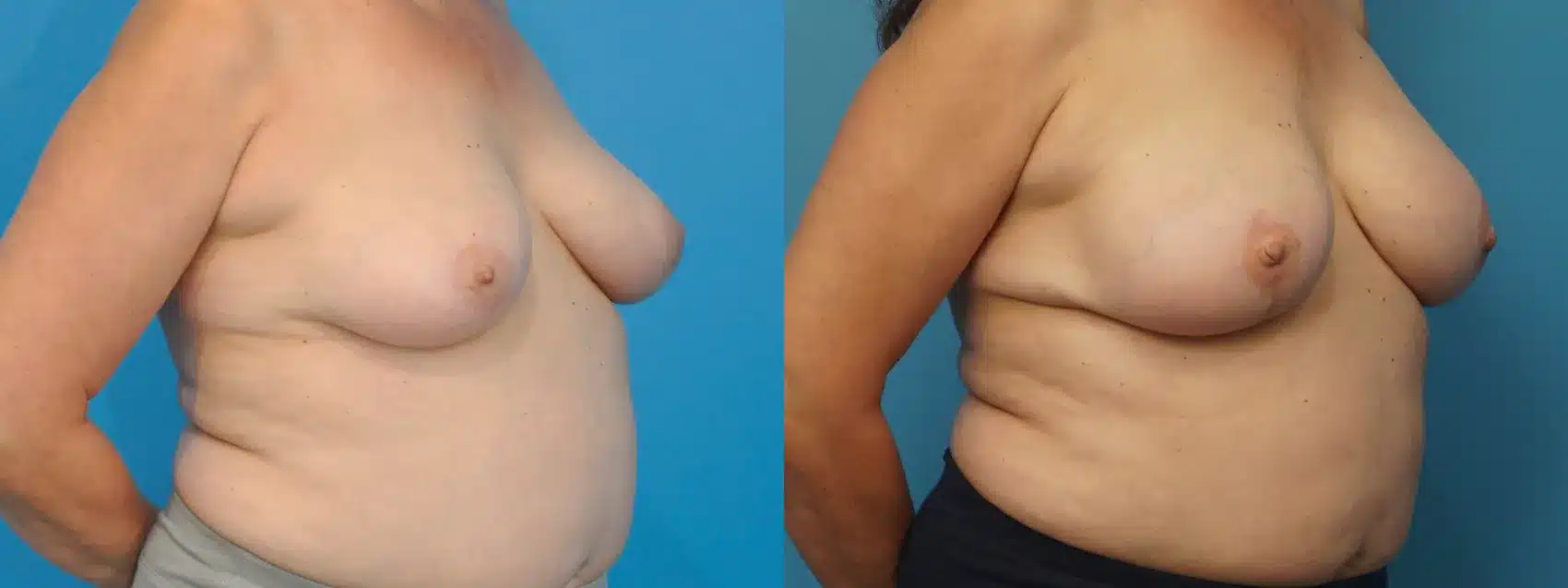 Before and After Image: Mastectomy Reconstruction with implants - right-front-oblique