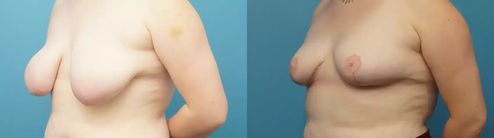 Before and After Image: Case #382 - left-front-oblique