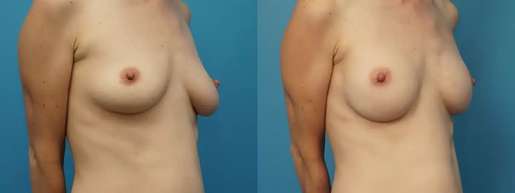 Before and After Image: Case #383 - right-front-oblique