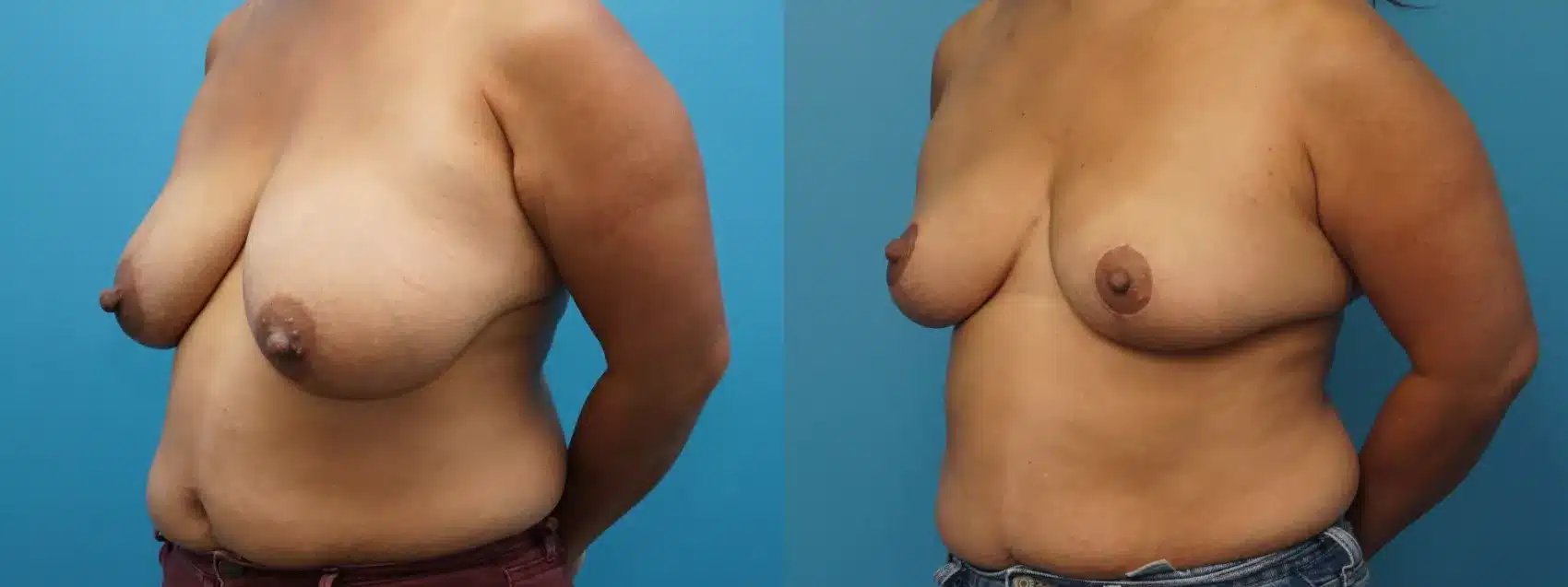 Before and After Image: Case #384 - left-front-oblique