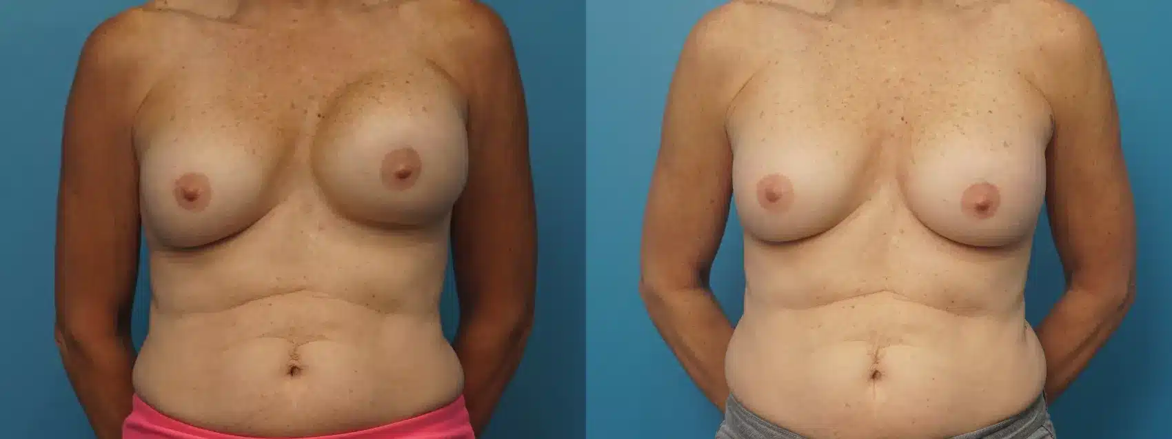 Before and After Image: Revision Breast Augmentation - front