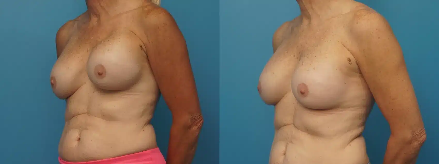 Before and After Image: Revision Breast Augmentation - left-front-oblique