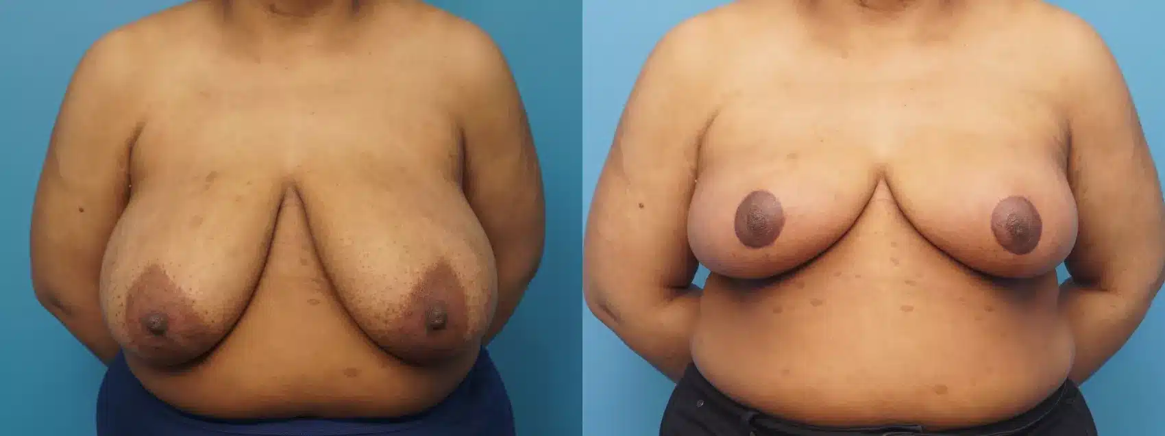 Before and After Image: Case #386 - front