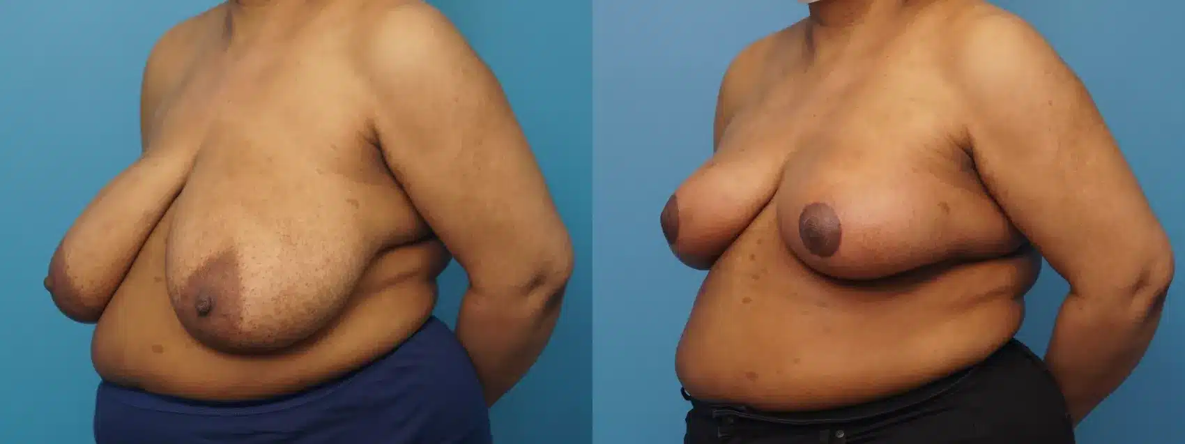 Before and After Image: Case #386 - left-front-oblique